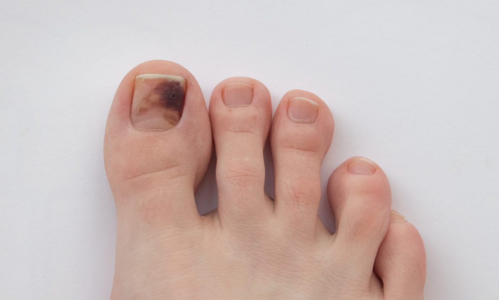 skin cancer melanoma in the toe nail