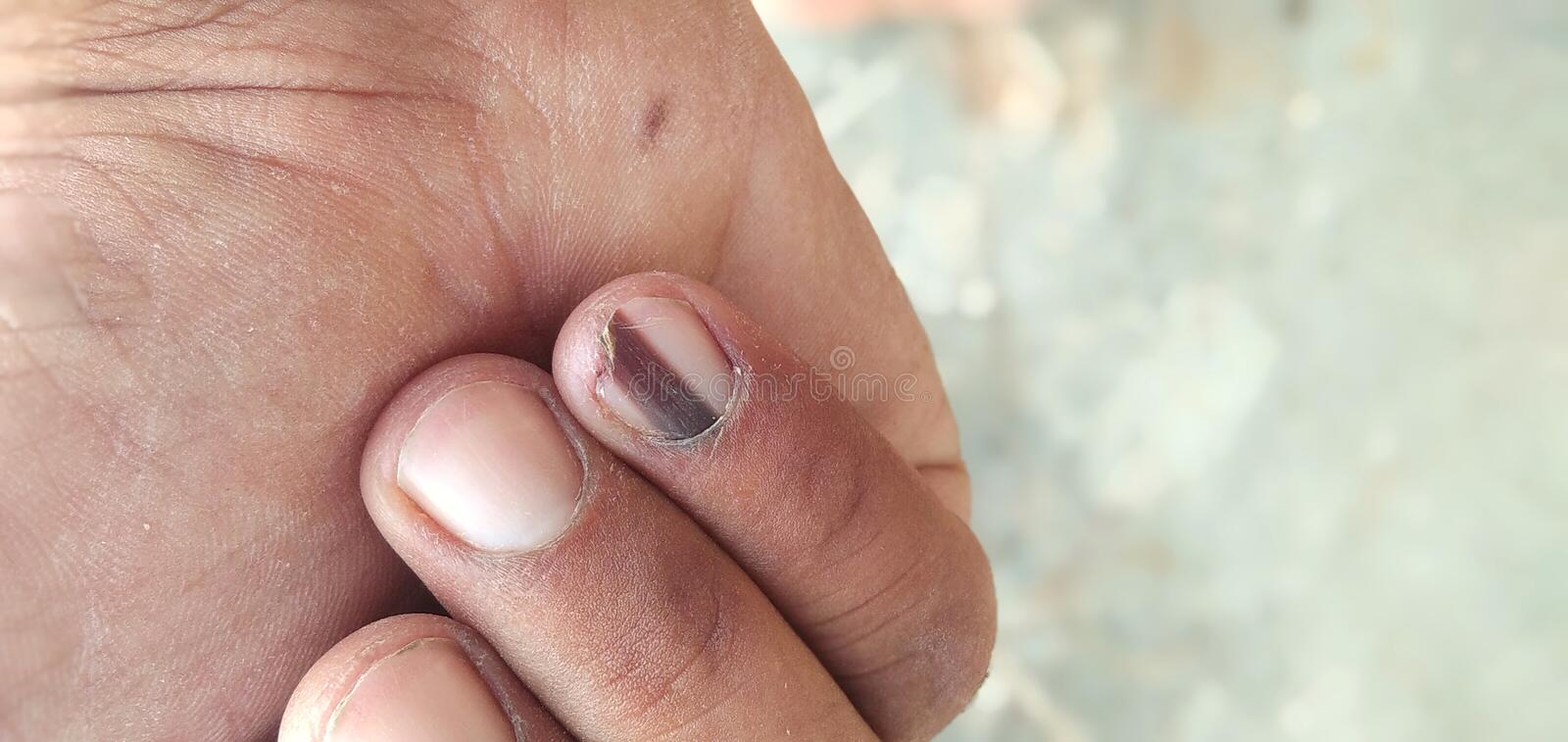 melanoma skin cancer in the nails
