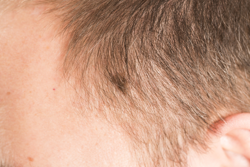 melnaoma skin cancer in the scalp