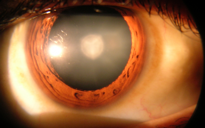 Basics of Cataract Surgery