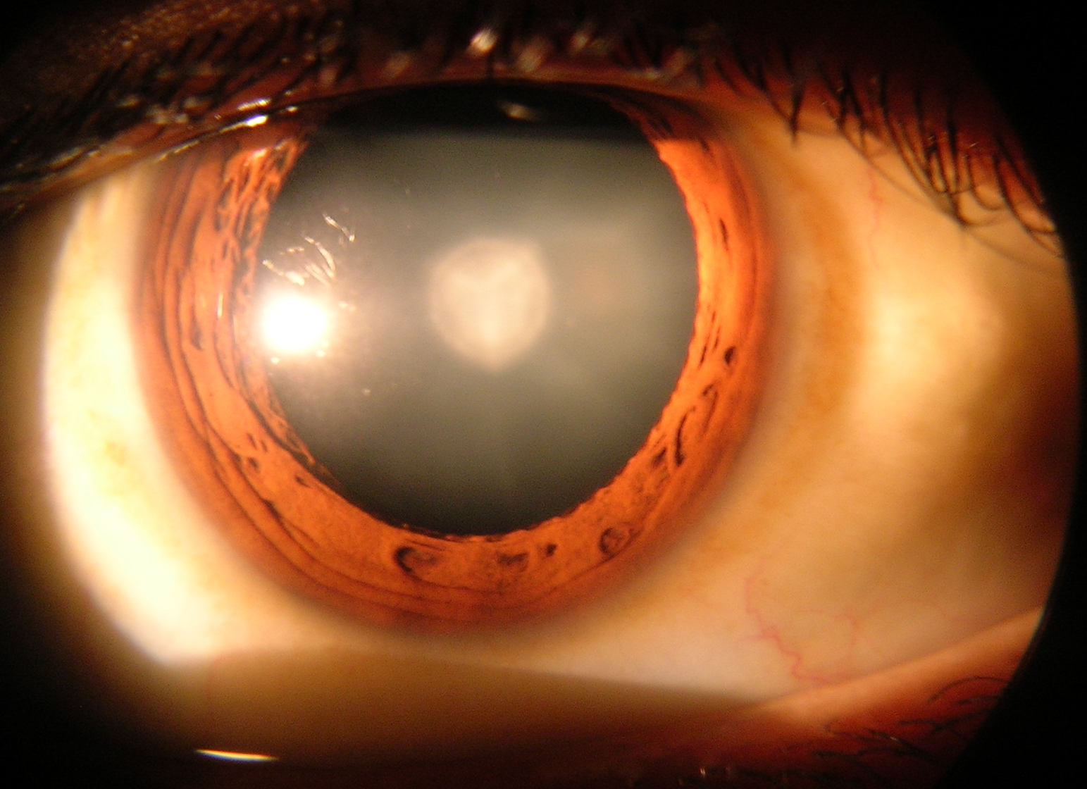 Slit lamp examination of a patient with early stage immature cataract